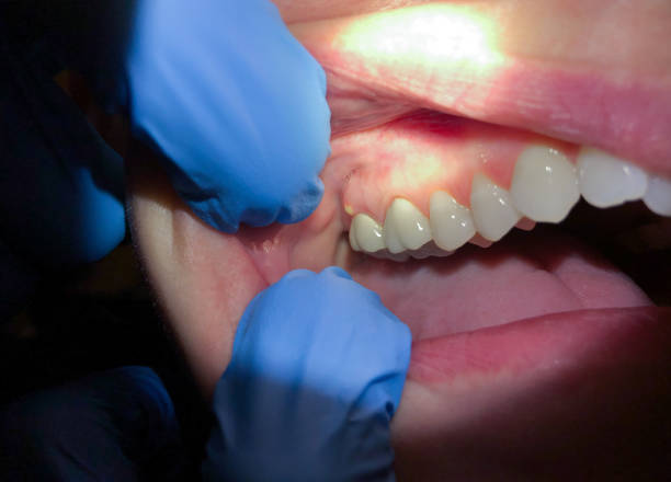 Best Tooth Infection Emergency Dentist  in Brewton, AL
